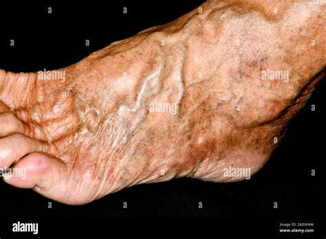 Varicose veins. Close-up of varicose veins on the foot of a 73-year-old ...