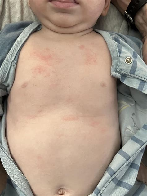 Peanut allergy rash goes away and returns for days after initial