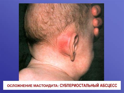 Острый средний отит. Мастоидит - презентация онлайн