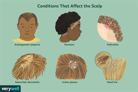 Seborrheic Dermatitis Scalp