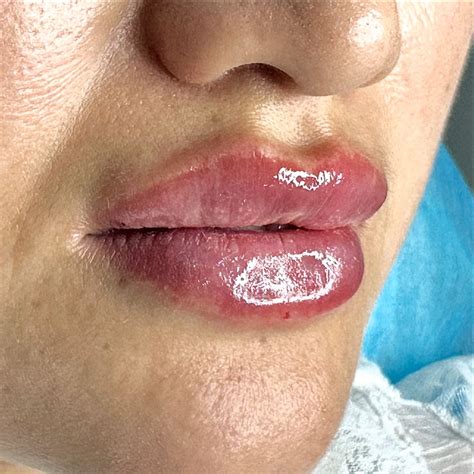 Аугментация губ 🫦. Усындай сулыу еринди калейсизбе? #cosmetologist ...