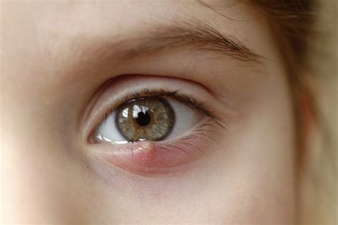 Kuliti (Stye) : Sintomas, Sanhi | Mediko.PH