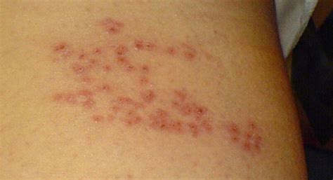 Shingles: Symptoms, Causes, and Treatment