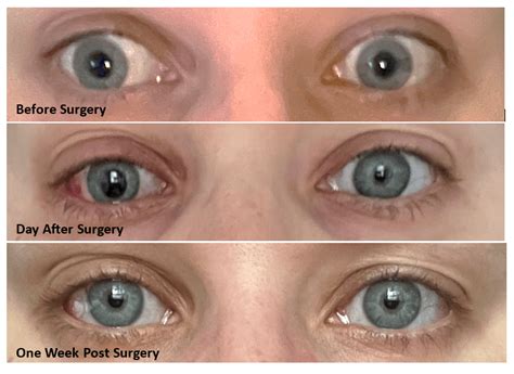 surgery results absolutely thrilled rstrabismus