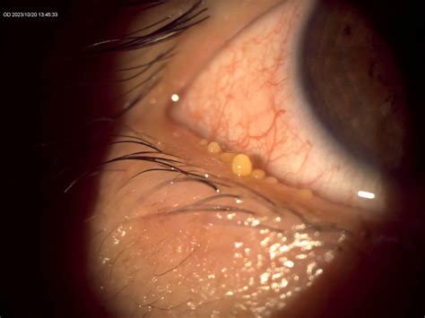 meibomian gland dysfunction treatment tools   trade current