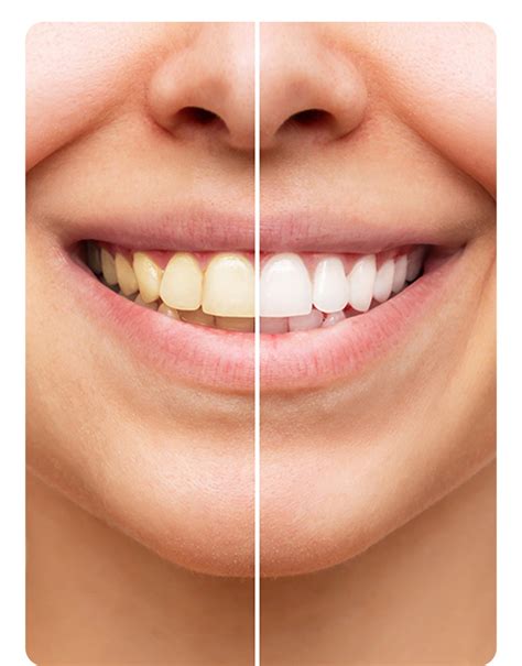 Fayetteville, NC Dentist Near Me | Aspen Dental