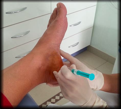 Mortons Neuroma Overview - Vada Spurgin