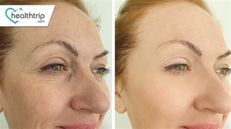 Chemical Peels: What to Expect Before, During, and After | HealthTrip