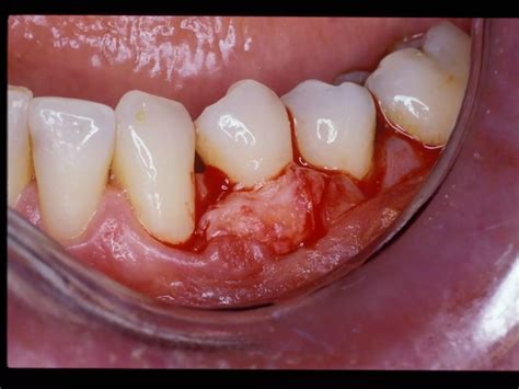 An Alternative to Autogenous Connective Tissue Grafting for Root