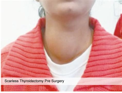 scarless Thyroid Surgery – Dr. Sudhi Agarwal Kamboj