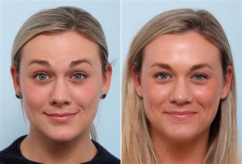 Botox - Pure Benefits