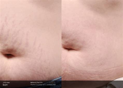 Laser Stretch Marks Rockville, MD - Olsen Aesthetics