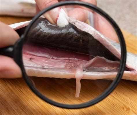 infezione da anisakis  anisakiasi sintomi diagnosi  cura