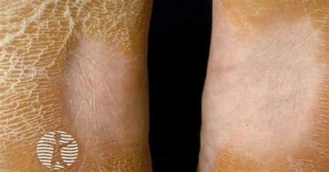 Diffuse palmoplantar keratoderma image
