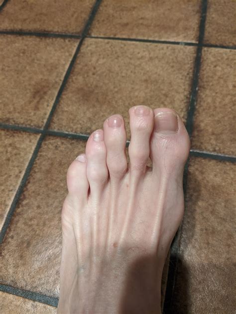 Long Ugly Toenails