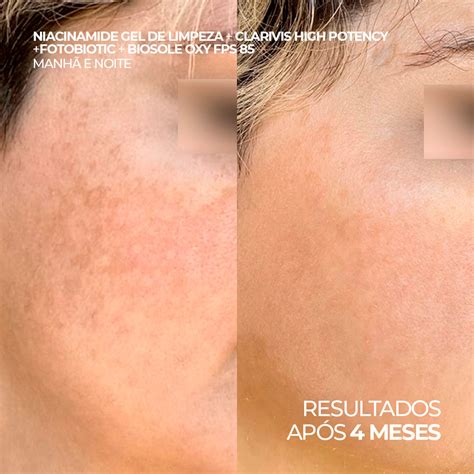 Serum Clareador Antes E Depois - Sérum Clareador de Manchas e Melasma - Alta Potência – ADA TINA