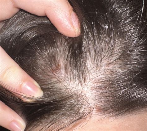 Im 23 and have been picking my scalp for around 12 years, noticed how