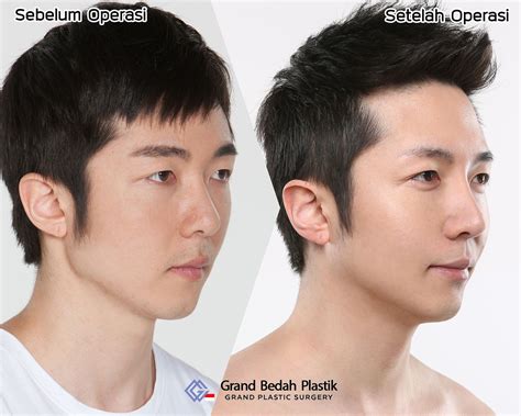 men nose jobs before and after 3