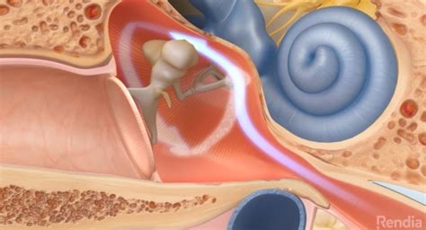 Eustachian Tube Dysfunction Archives - ENTJC