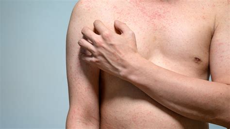 The measles symptom you might spot in the morning – and 6 other signs as cases surge and man ...