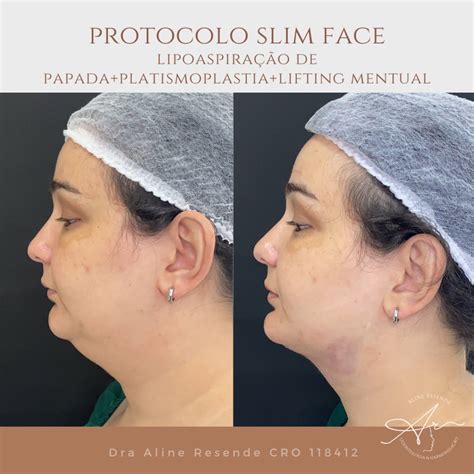 Platismoplastia O Que É - Platismoplastia - o que é? - Clínica Aline Resende