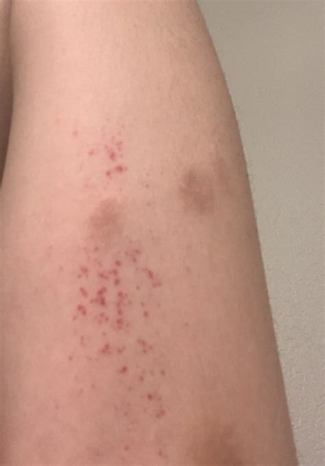Why Do I Have A Rash With Red Dots at Melissa Townson blog