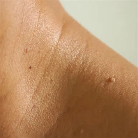 Skin Tags for Trumbull, Westport and Derby, CT | Adult & Pediatric ...