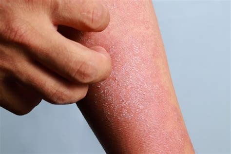 signs  rash   psoriasis jordan valley dermatology