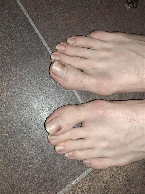 Subungal melanoma? : r/Melanoma