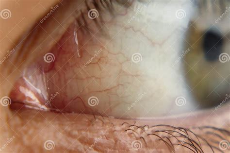 Veias Vermelhas No Olho - Tiro Ao Fundo De Um Irritado Olho Vermelho E Veias No Globo Ocular De ...