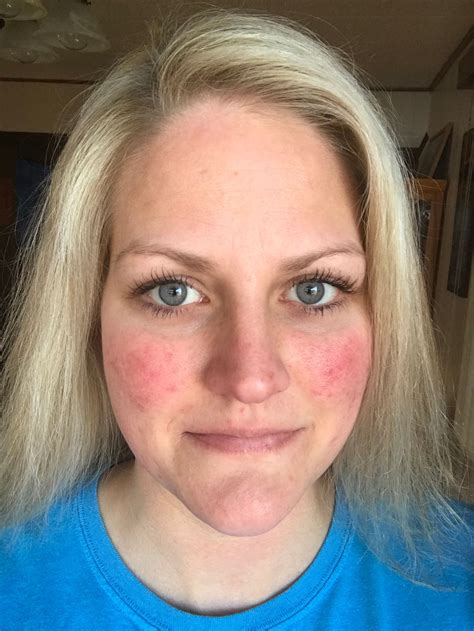 Why Do I Get Red Spots On My Face After Showering - Infoupdate.org