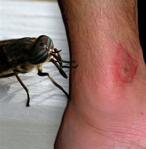 horsefly bites identification  treatment exaip