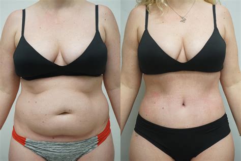 Stomach Liposuction Before And After Women