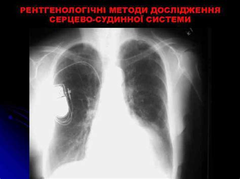 ПРОМЕНЕВІ МЕТОДИ ДОСЛІДЖЕННЯ ТА ПРОМЕНЕВА АНАТОМІЯ ОРГАНІВ ГРУДНОЇ