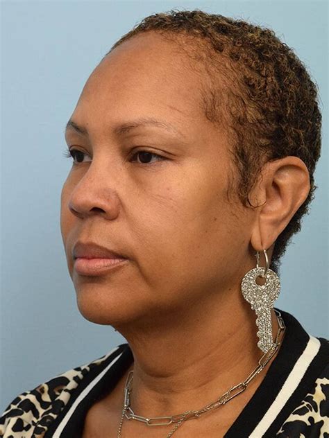 Before & After Face & Neck Lift Bellaire | Face Forward