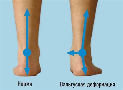 Вальгусная деформация стопы у детей и взрослых. Лечение в Москве - Ист ...