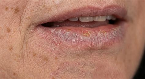 Queilite Actínica Fotos - Queilitis actínica: síntomas, diagnóstico y tratamiento