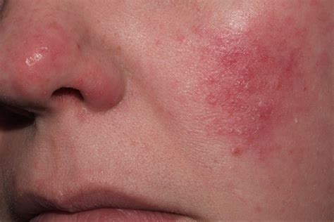 rosacea granulomatosa symptome tjnhsn