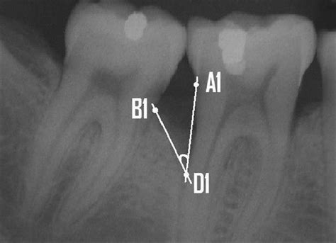 horizontal alveolar bone loss  periodontal orphan