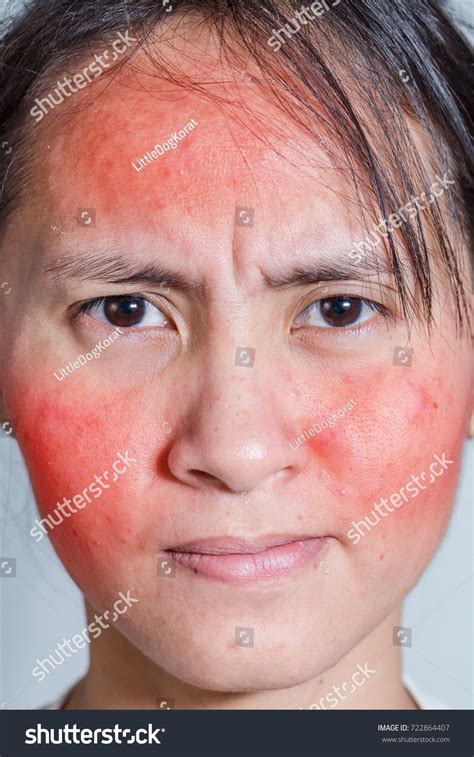 Face Young Woman Rash Allergic Reaction Stock Photo 722864407 ...
