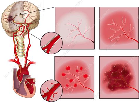 Progression of embolic stroke, illustration - Stock Image - C059/3360 ...