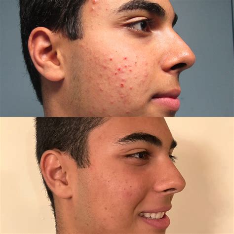 Accure Laser Before and After | Dr. Cameron Rokhsar