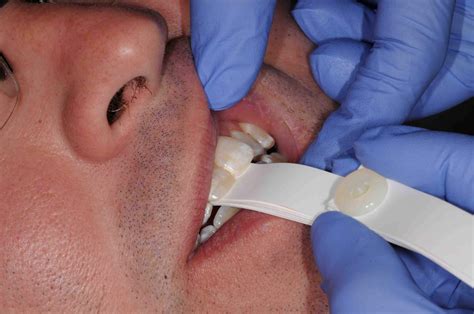 A Critical Step in Digital Occlusal Diagnosis - Restorative Nation