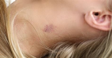 Unleash Your Inner Lifesaver Understanding The Hickey Stages Of Bandages