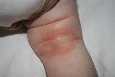 Eczema On Legs Baby