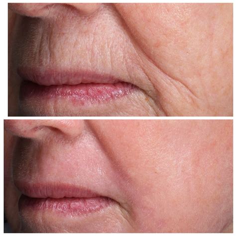 laser surgery toby nelson dermatology