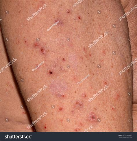 Face Rash Elderly at Rachel Vance blog