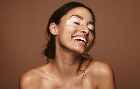 Vitiligo: Causes, Treatments, and More | POPSUGAR Beauty