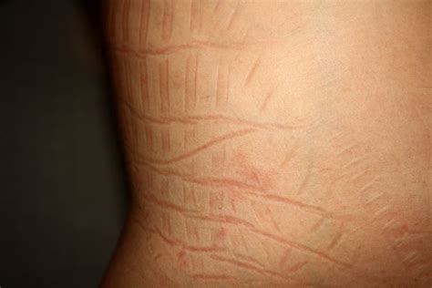 Marks on skin after wearing the cardboard corset. | Corset, Corsetry ...