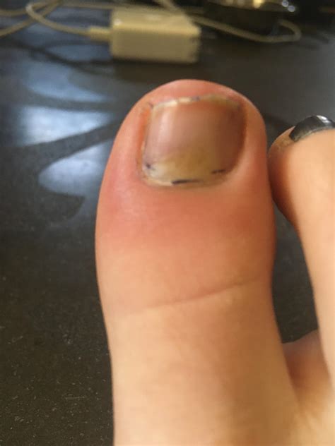 Uv Light Kill Toenail Fungus at Frank Hansen blog